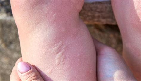 Cold Urticaria: What It Is, Symptoms, Causes & Treatment