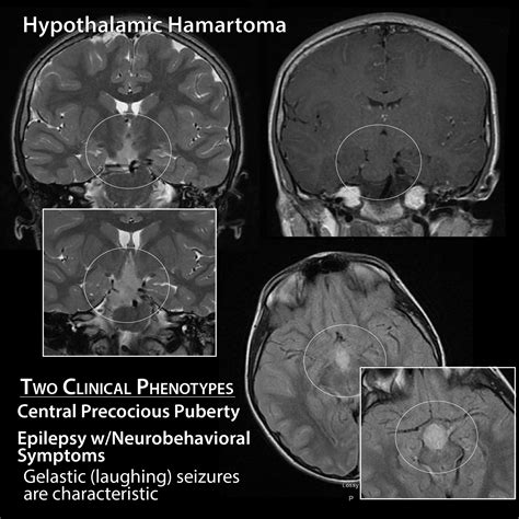 Clinical Pathology Glossary: Hypothalamic Hamartoma | ditki medical ...