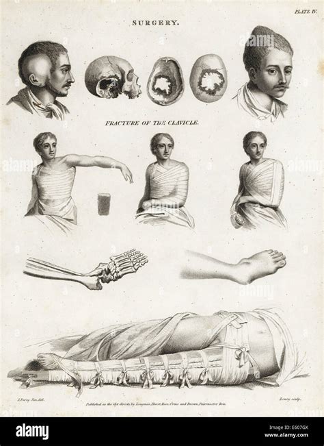 Surgical procedures from the 19th century Stock Photo - Alamy