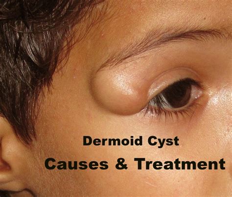 Dermoid Cyst - Causes, Pictures, Symptoms And Treatment