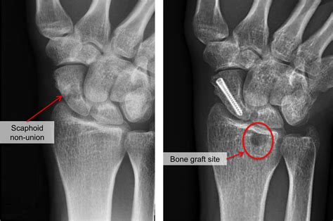 Scaphoid Fracture Cast Time