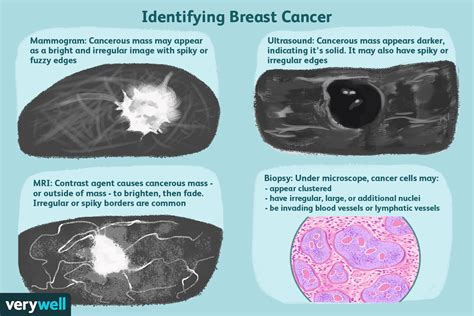 What Does Breast Cancer Look Like On An Ultrasound