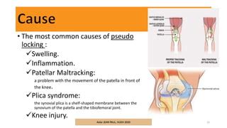 Knee Locking What Causes Locked Knee And How Is It Treated? | atelier-yuwa.ciao.jp