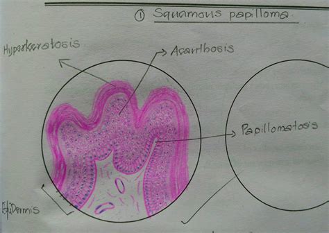 Histopathology Drawings: Squamous papilloma