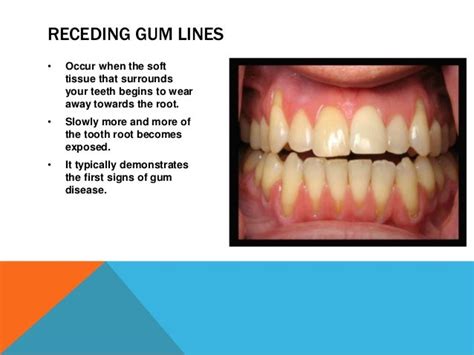 What Causes a Receding Gum Lines