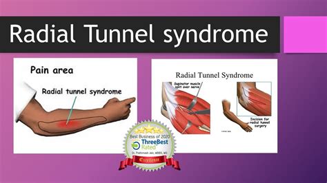 Radial Tunnel Syndrome - YouTube