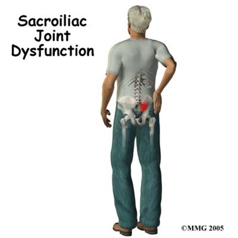 Si joint dysfunction | SASSI-Strengthen & Stabilize your SI Joints