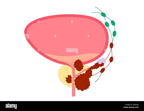 Prostate cancer, illustration Stock Photo - Alamy