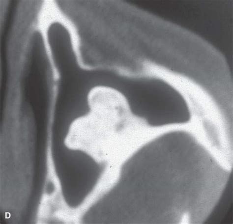 Benign and Malignant Osteogenic Tumors of Bone | Radiology Key