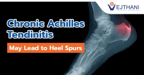 Aggregate more than 126 achilles heel spur symptoms latest - esthdonghoadian