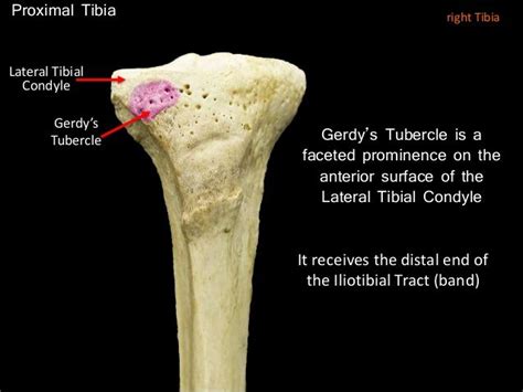 gerdy's tubercle | It band, Band, Knee pain