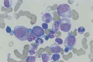 Neutrophils Figure 172a Development and function - Haemolytic Anaemia