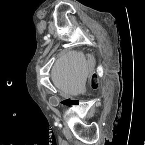 Laparoscopic view of strangulated obturator hernia. A: obturator canal ...