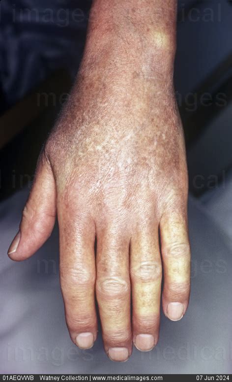 STOCK IMAGE, close-up of scleroderma with inflammation and thickening ofthe skin on the left ...