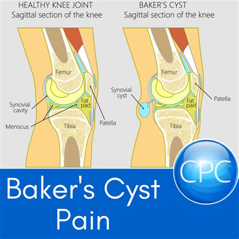 Baker's Cyst Pain | Carolina’s Pain Center