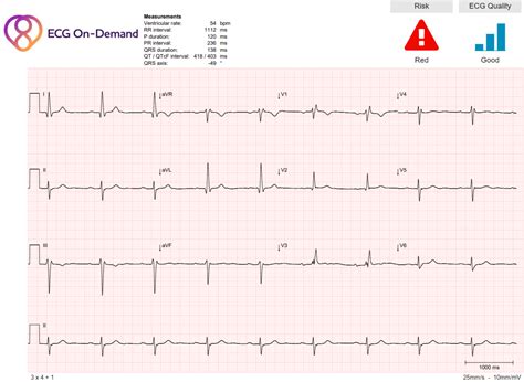 Sinus bradycardia RBBB, LAFB, 1stDegree Trifascicular block ...