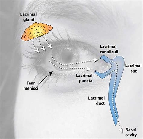 Supernumerary punctum: an unusual case of seeing double - Lacroix ...