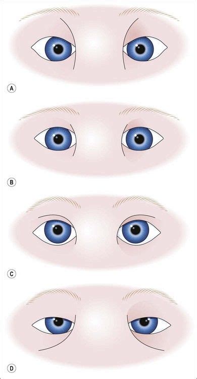 Epicanthus. (A) Superciliaris; (B) palpebralis (most frequent); (C ...