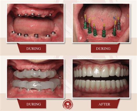 Prettau Dental Implant Full Mouth Bridge | Alternative to All-on-4 | Ramsey A. Amin, DDS