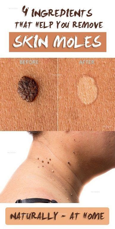 4 Ingredients that Help you Remove Skin Moles Naturally. | Mole removal ...