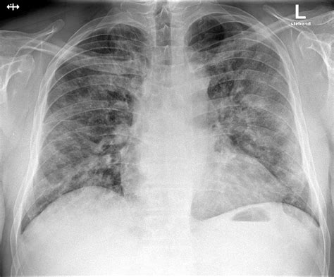 D-dimer and mortality in COVID-19: a self-fulfilling prophecy or a pathophysiological clue?