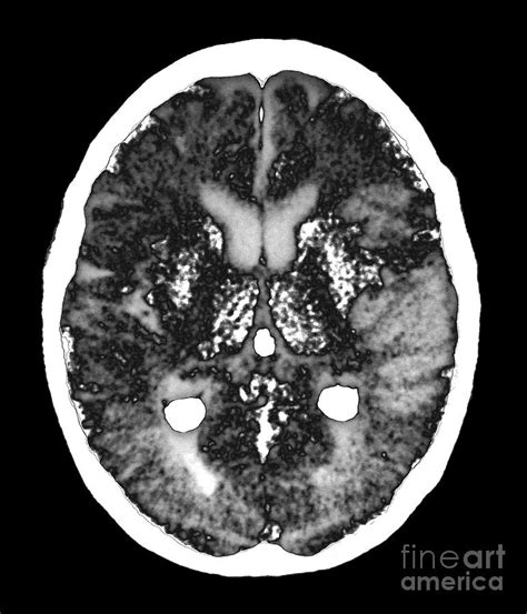 Stroke Brain Damage Photograph by Zephyr/science Photo Library