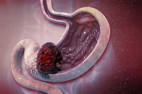 Stomach Cancer. Cancer Attacking Cell Stock Illustration - Illustration of carcinogen, cramp ...