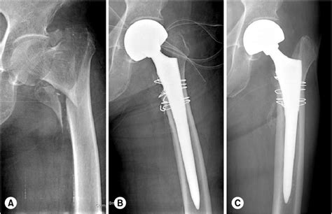 (A) Preoperative radiograph of a 71-year-old female shows unstable... | Download Scientific Diagram