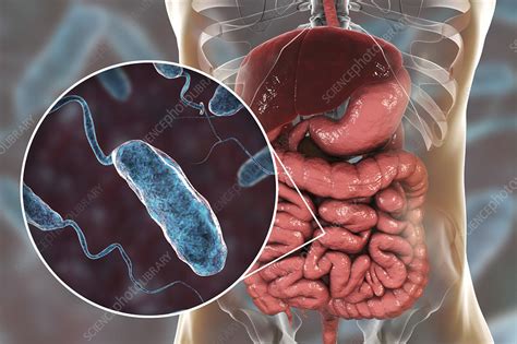 Cholera infection, illustration - Stock Image - F023/9704 - Science ...