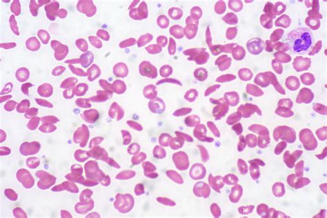 Sickle Cell Anemia | Peripheral blood smear | Ed Uthman | Flickr