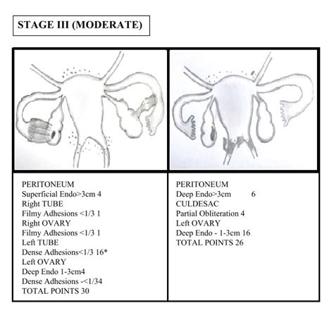 What Are The Stages Of Endometriosis