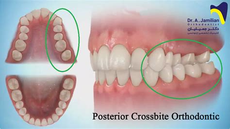 Posterior crossbite orthodontic - Dr Jamilian