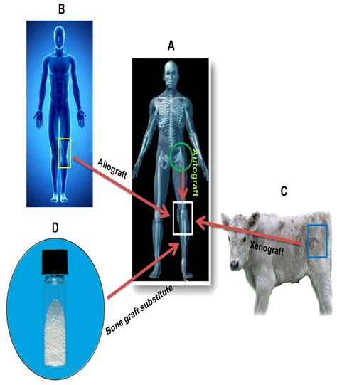 Types of bone grafts. (A) Autograft: The surgeon harvests bone from... | Download Scientific Diagram