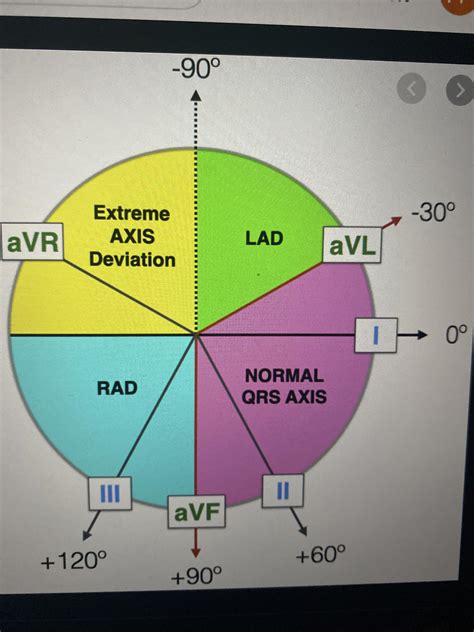 What does a ‘superior’ QRS axis mean relative to this diagram? I’m trying to understand the ECG ...