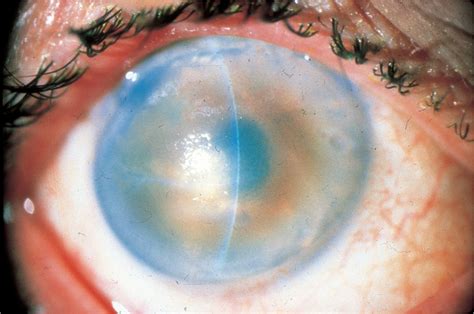 Complications of Cataract Surgery | Ento Key