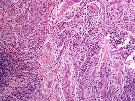 Angiolymphoid hyperplasia with eosinophilia - Alchetron, the free ...