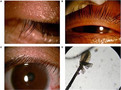 Frontiers | Association Between Demodex Infestation and Ocular Surface Microbiota in Patients ...