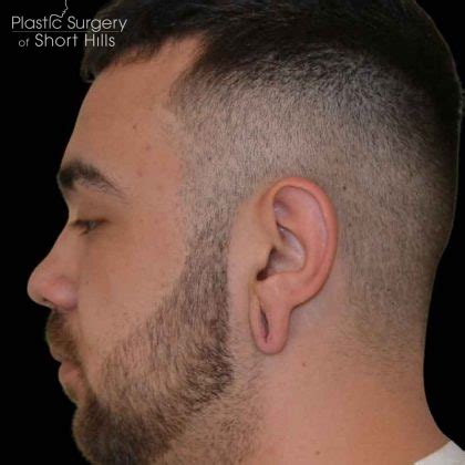 Patient #16568 Earlobe Repair Before and After Photos New Jersey - Plastic Surgery Gallery New ...