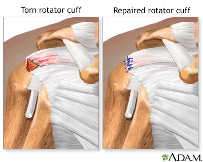 Rotator cuff repair | Multimedia Encyclopedia | Health Information | St. Luke's Hospital