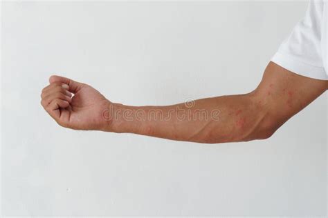 Rash, Rashes Caused by Allergic Reactions on Arms. Stock Photo - Image of sore, reactions: 205452228