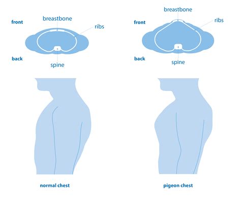 Pectus carinatum (pigeon chest) | Asthma + Lung UK