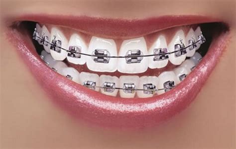 👉 Porcelain Braces - Cost, Pros and Cons, Pictures (December 2021)