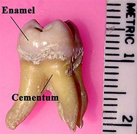 What is This Notch on My Teeth at the Gumline?