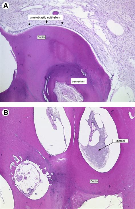 Complex Odontoma Histology