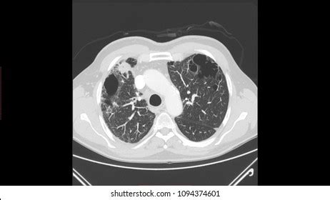 Lung Emphysema Ct Scan Stock Illustration 1094374601 | Shutterstock