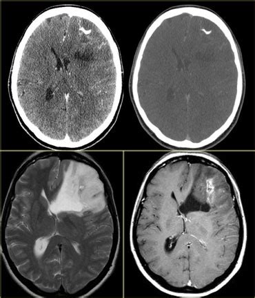 Cat Scan Brain Tumor