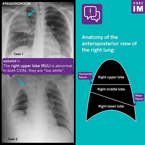 Lung Consolidation Vs Pleural Effusion