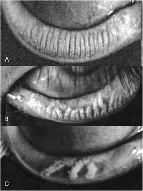 Meibomian Gland Scale