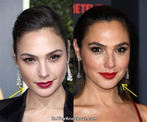 Gal Gadot Plastic Surgery Comparison Photos