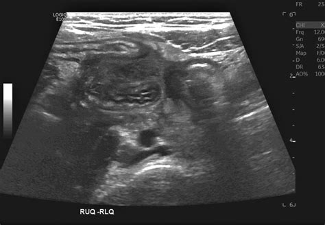 Ruptured Appendix Ultrasound